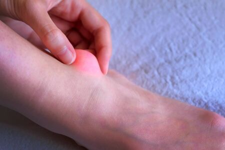 Woman palpates hand leg ankle hygroma in joint, foot closeup view on white background. Tumor, inflammation of the ankle joint of left leg. Trauma, shock, swelling of internal tissues. Joint disease.の写真素材