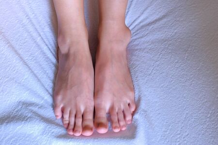 Tumor, trauma, inflammation of joint, leg ankle hygroma in joint, feet closeup on white background. Trauma, shock, swelling of internal tissues. Joint disease.の写真素材