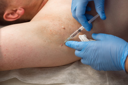 Surgeon in gloves gives injection of local anesthesia to patient before laser removing of moles or papillomas, closeup armpit. One day surgery concept. Removing nevus or birthmark. Cosmetic treatment.の写真素材