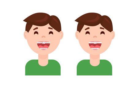 Braces dental treatment before and after. Cute cartoon boy with teeth braces. Smiling kids with a nice smile after wearing braces vector illustrationのイラスト素材