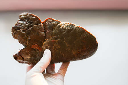 a piece of lung in the hands of the doctor. Affected organs, smoker, tuberculosis, covid virus. Diseases, treatment of respiratory diseases.の写真素材
