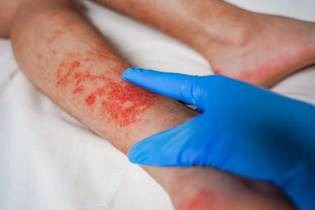 Eczema Skin disease on the legs, itchy red rashes and spotsの写真素材