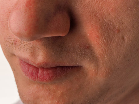 Close up face of young man with very dry skin. Problem of winter season.