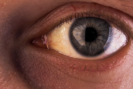 Obstructive Jaundice with severe yellowish discoloration of Eyes.