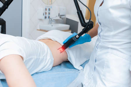 Laser hardware removal of a scar in modern cosmetology.の写真素材