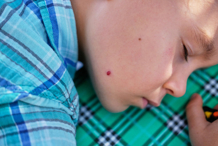 Vascular hemangioma boy cheek. Sad grim child. Concept: medicine, childhood diseasesの写真素材