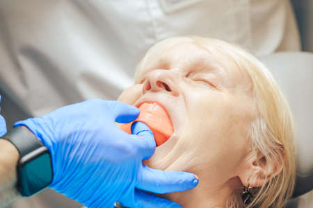 Prosthetics of the removable jaw of an elderly woman. Close-up of the doctor trying on a sample.の写真素材