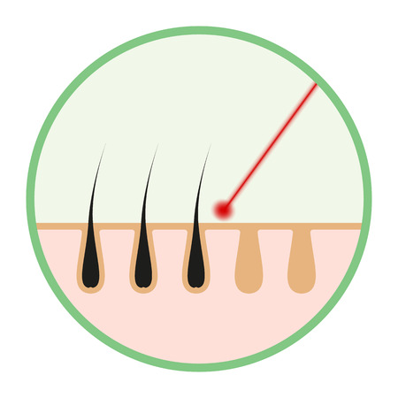 Icon illustration of skin hair. Vector element on isolated background for cosmetic laser hair removal projects, medicine.のイラスト素材
