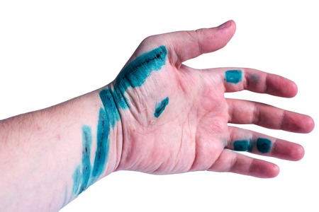 scratched hand treated with antisepticの写真素材
