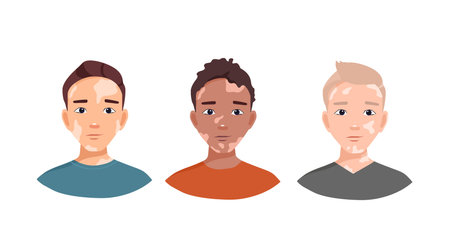 Guys with vitiligo. Ideas of different beauty, body positive, self-acceptance. Skin disease. Cartoon...