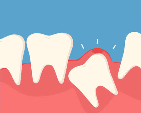 Inflammation of the tooth under the gum causes pain in the mouth. The concept of dental care. Vector cartoon illustration.のイラスト素材