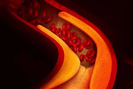 Cholesterol blocking artery. 3d illustration	の写真素材