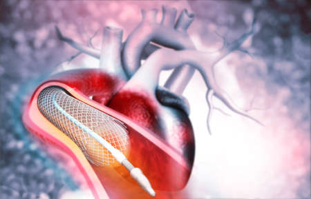 Human heart angioplasty. 3d illustration	の写真素材
