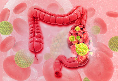 Colon cancer. Virus cells on colon. 3d illustrationの写真素材