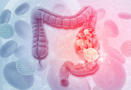 Colon cancer. Virus cells on colon. 3d illustration の写真素材
