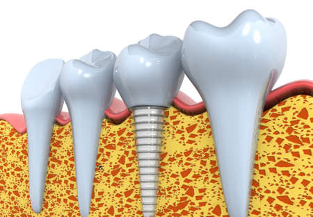 Dental implants instead of Damaged Teeth. 3d renderの写真素材