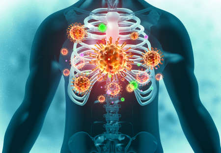 Human lungs infected by virus and bacteria. 3d illustrationの写真素材