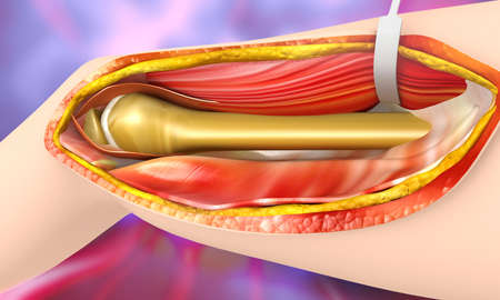 Leg femur surgery. 3d illustration の写真素材