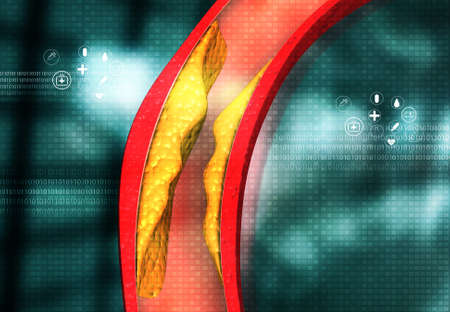 Cholesterol blocked artery on medical background. 3d illustrationの写真素材