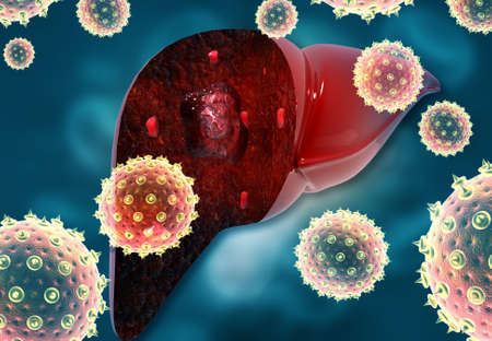 Virus infected human liver. 3d illustrationの写真素材