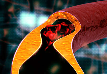 Atherosclerosis, Cholesterol plaque in artery. 3d illustration	の写真素材