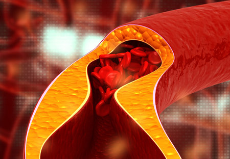 Atherosclerosis, Cholesterol plaque in artery. 3d illustration	