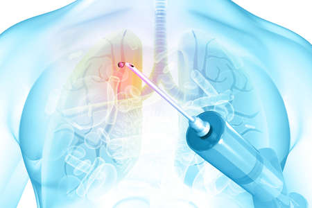 Human lungs with medicine syringe. 3d illustration	の写真素材