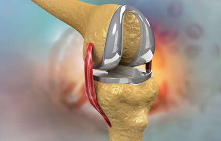 Steel knee cap on knee joint. 3d illustrationの写真素材