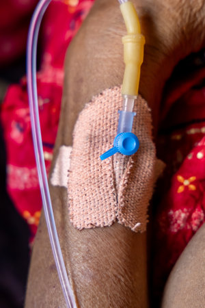 intravenous line inserted in patient hand under daylightの写真素材