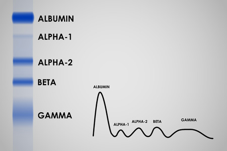 Typical result of blood serum protein gel electrophoresis testのイラスト素材