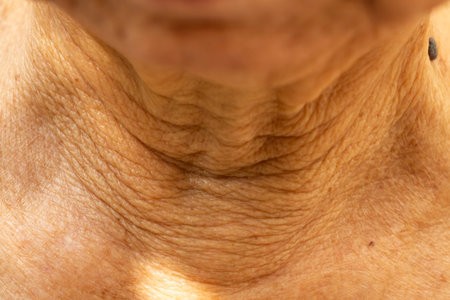 Senior woman's wrinkled neck, Black mole, Medicine, Close up & Macro shot, Selective focus, Body...