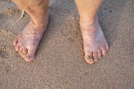 Senior woman's feet are standing on sandy beach, Varicose veins on leg and feet, Asian Body skin...