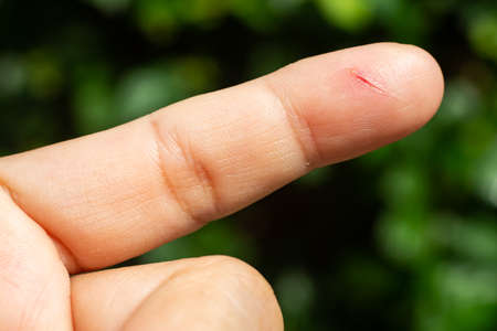 Woman has been cut index finger and scar skin on hand, Close up & Macro shot, Asian Body skin part, Healthcare concept, Bokeh green garden backgroundの写真素材