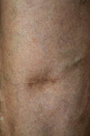 Scar from operate on Varicose veins on a leg in Senior women, Close up & Macro shot, Selective focus, Body skin part, Healthcare conceptの写真素材