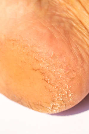 Woman' s heel break skin on white background, Close up & Macro shot, Asian Body skin part, Healthcare conceptの写真素材
