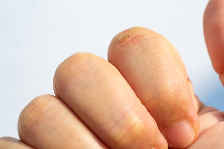 Woman peeled index finger and scar skin on hand, White background, Close up & Macro shot, Asian Body...