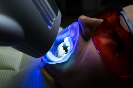 Adult female receiving teeth whitening procedure.portrait of a female patient at dentist in the clinic. Teeth whitening procedure with ultraviolet light UV lamp. LED lamp for Teeth whitening procedureの写真素材
