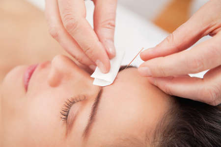 Acupuncture needles on head of a young woman at the spa