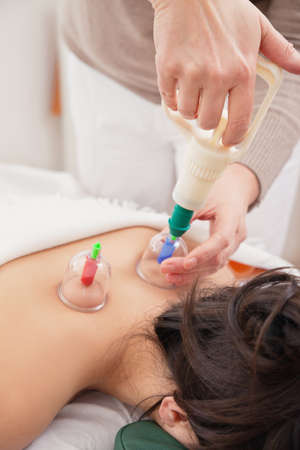 Alternative Medicine Acupressure. Suction pressure being applied via glass cups to a womans back to...
