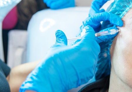 Hands of a dermatologist filling with hyaluronic acid. Biorehabilitation, procedure with anti-aging wrinkle fillerの写真素材