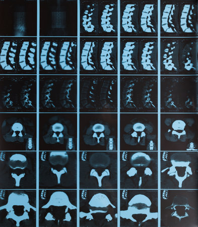 Detailed spine analysis through a series of X-ray images from various angles in a medical evaluationの写真素材