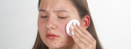 Acne cleansing on facial skin in routine. Acne treatment with cotton pad for skincare. Acne care for...