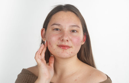 Pimple on face. Skin acne texture. Close up pimple skin. Problem skin with pimple. Pimples, acne,...