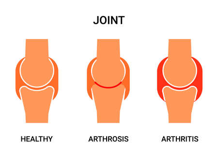 Human joint, healthy, atritis and arthrosis. Joint pain, abrasion of cartilage, inflammation of the joint capsule. Vector illustrationのイラスト素材