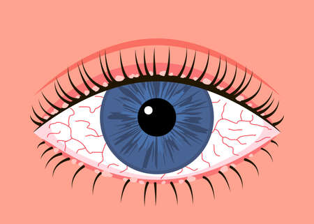 Inflamed sick human eye with blepharitis, allergy symptom red veins. Eye disease, fatigue or...