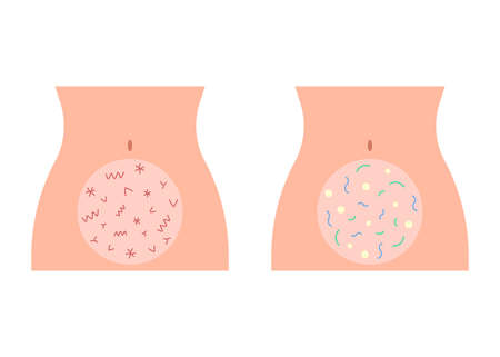 Good healthy and bad pain microflora in abdomen intestine. Digestion bowel. Female body figure with harmful and beneficial bacteria. Vectorのイラスト素材