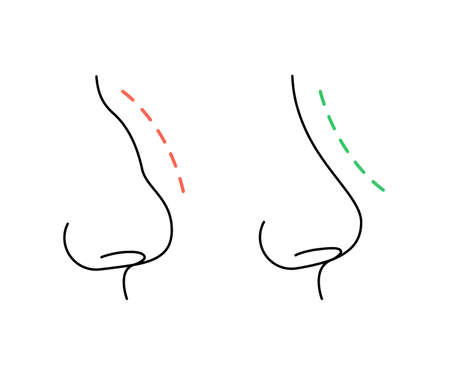 Correction of profile of nose line, changing nasal shape during rhinoplasty surgery. Hump nose and straight nose. vectorのイラスト素材