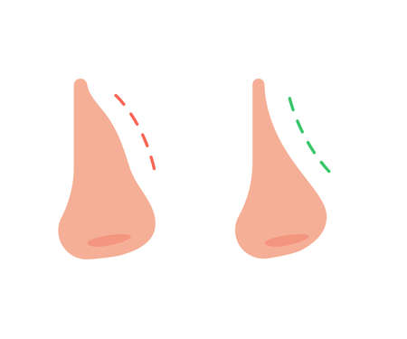 Correction of profile of nose line, changing nasal shape during rhinoplasty surgery. Hump nose and straight nose. vectorのイラスト素材