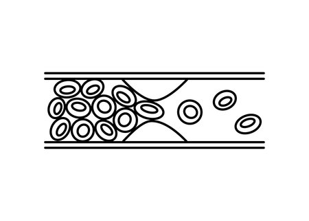 Deep vein thrombosis DVT, artery and vein disease with fat cells, line. Abnormally of blood vascular flow. Cholesterol in blocked in human blood vessel. Vectorのイラスト素材