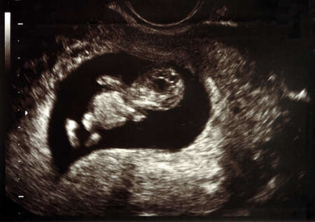 Ultrasound scans during pregnancy in the eleventh week 